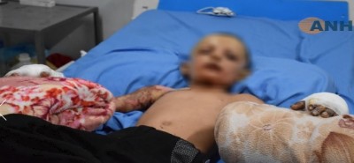 kurdish_child_probably_hit_by_chemical_ammunitionhawarnews__ef_screenshot_400